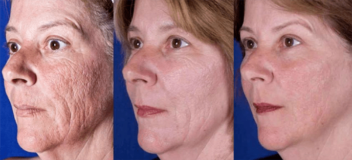 Resultado após rejuvenescimento da pele facial a laser