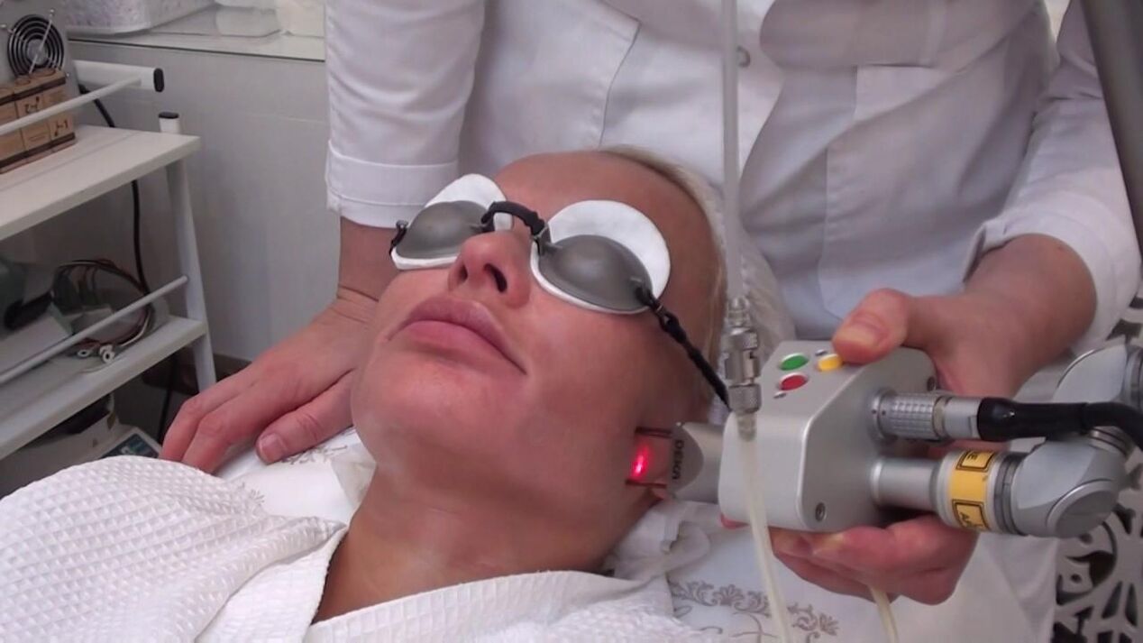 Tratamento com feixe de laser em áreas problemáticas da pele facial