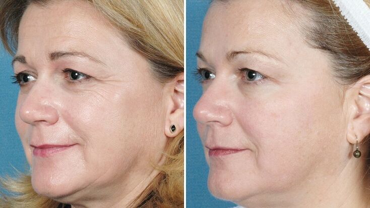 Fotos antes e depois do rejuvenescimento da pele