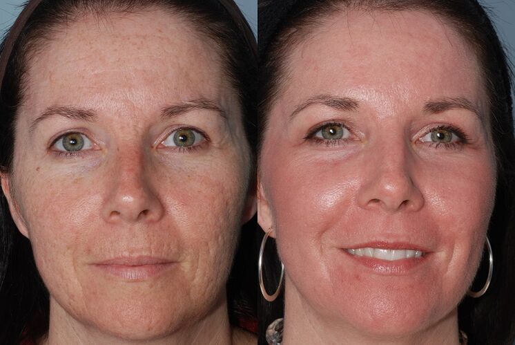 antes e depois do rejuvenescimento da pele