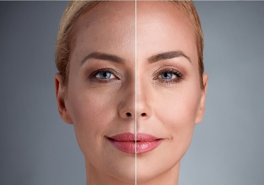 antes e depois do rejuvenescimento facial a laser